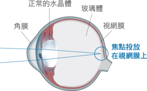 白內障微創手術-正常水晶體