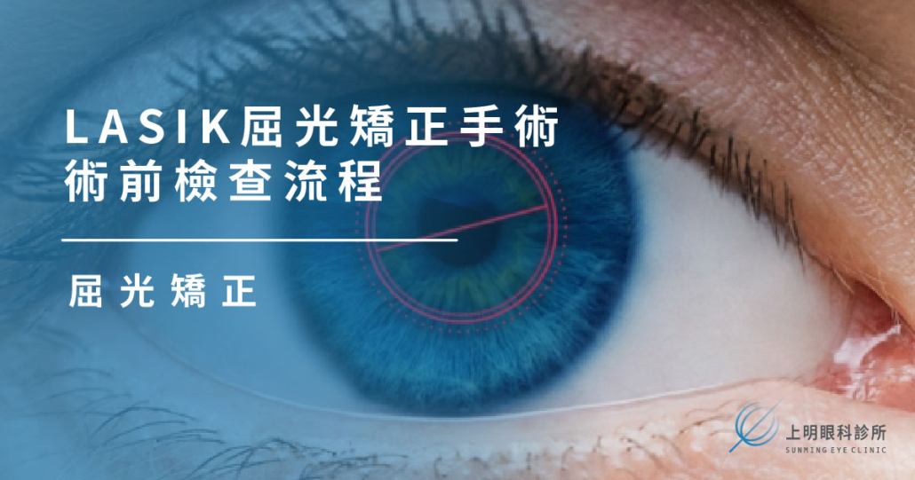 屈光矯正|LASIK屈光矯正手術術前檢查流程 - 上明眼科