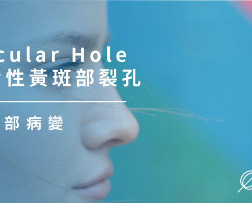 黃斑部病變｜Macular Hole 原發性黃斑部裂孔