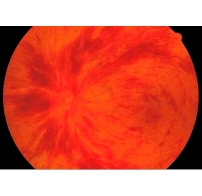 眼中風（Retinal vascular occlusion）視網膜血管阻塞