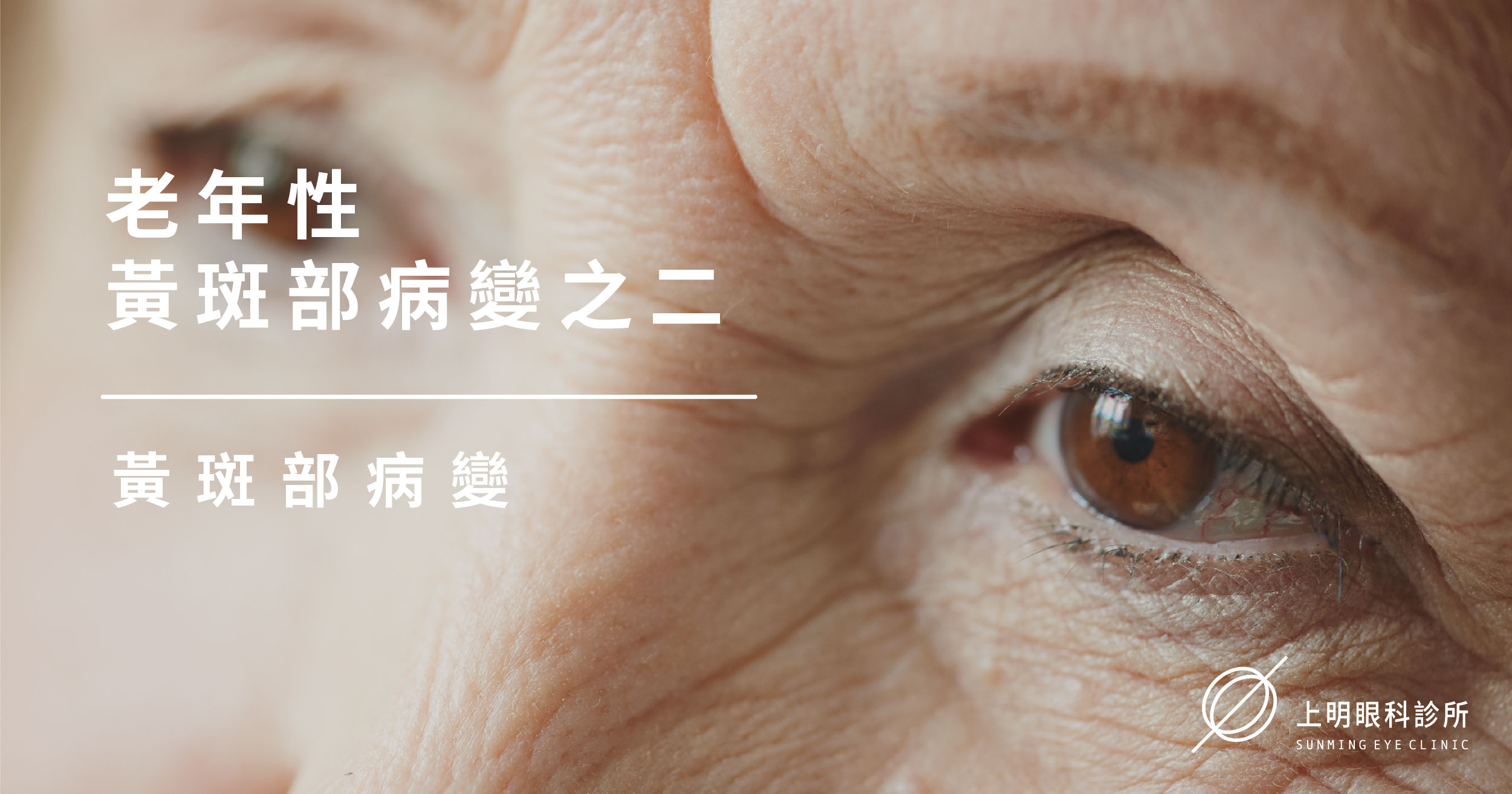 老年性黃斑部病變AMD-2