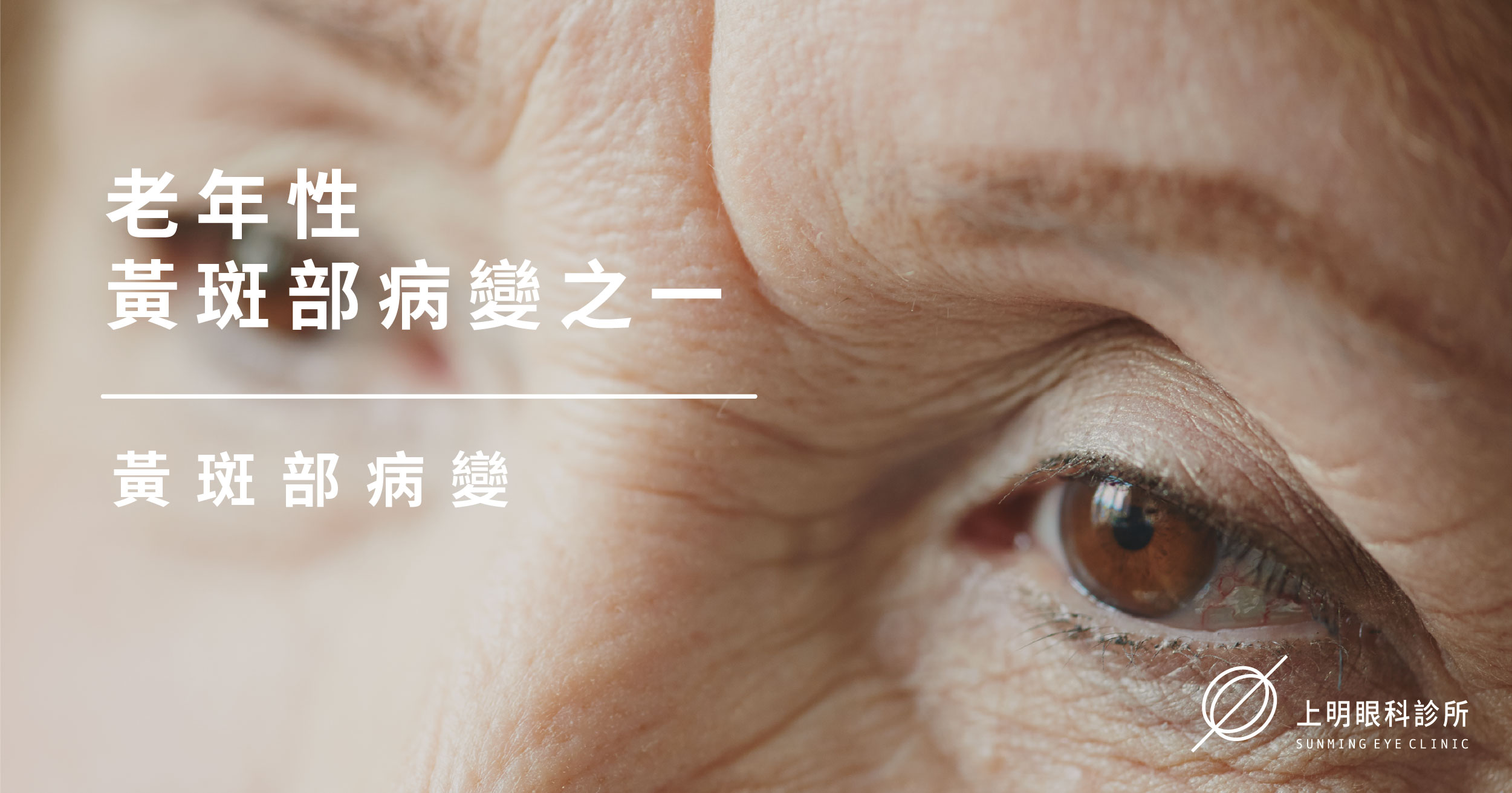 老年性黃斑部病變AMD-1