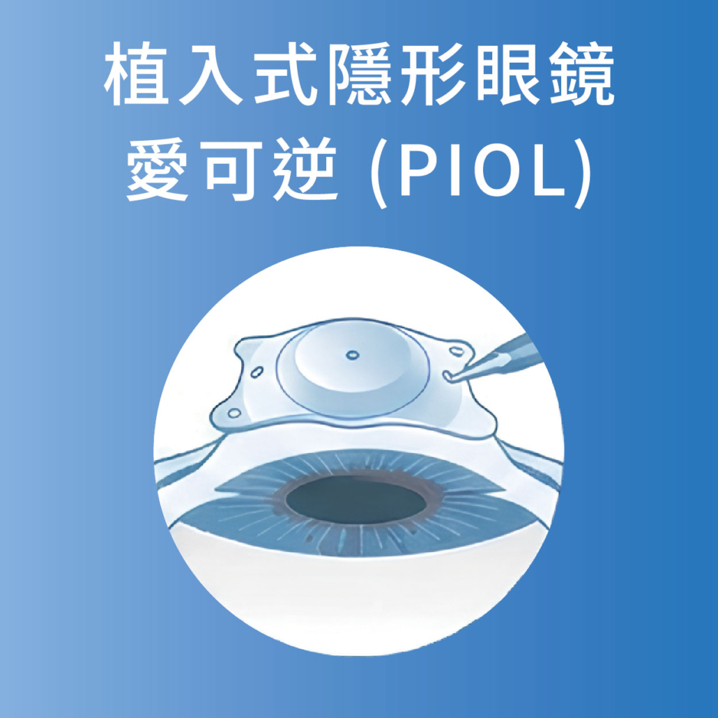愛可逆 PIOL 植入式隱形眼鏡示意圖