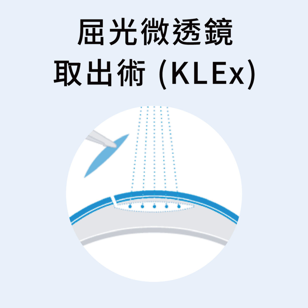 SMILE／SiLK 屈光微創透鏡取出手術示意圖