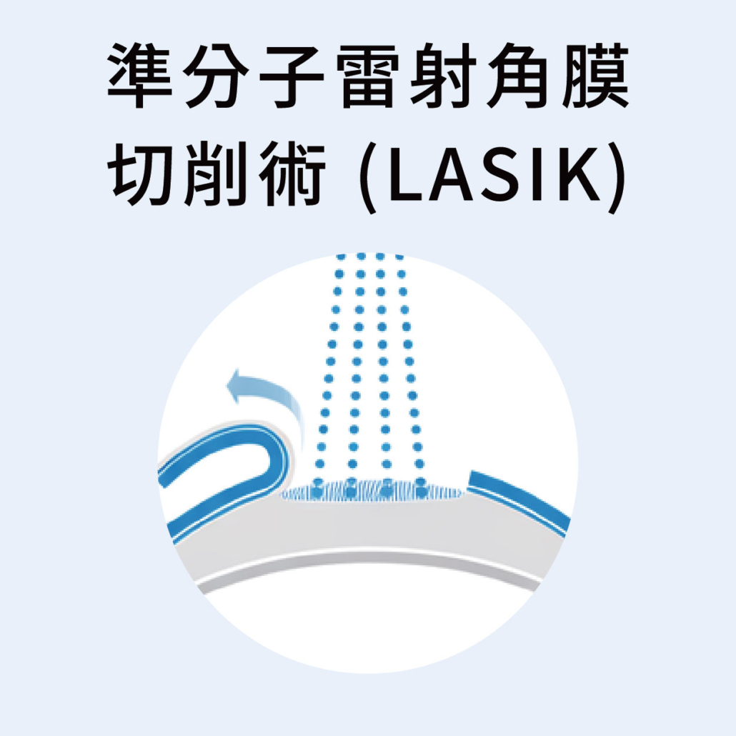LASIK 屈光雷射手術示意圖