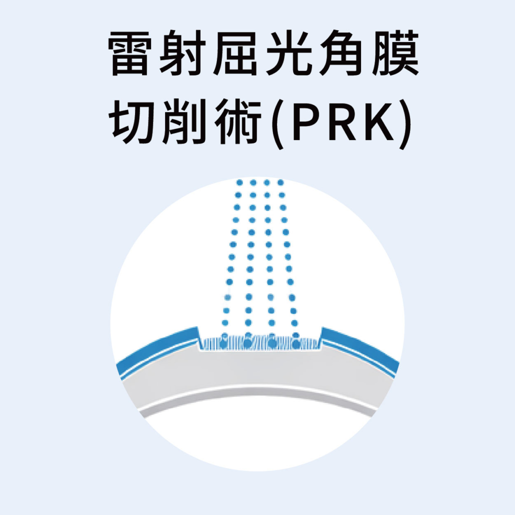 Trans PRK 雷射屈光角膜切削術示意圖